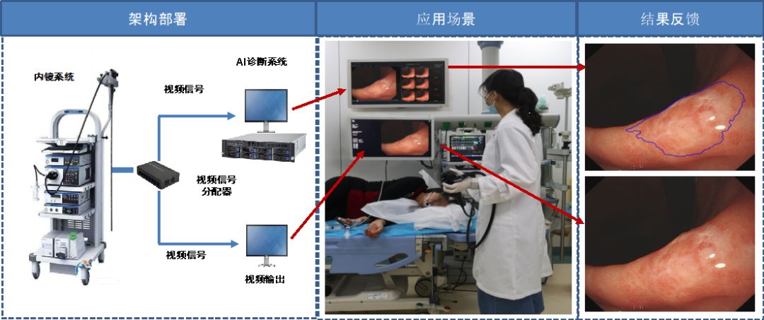 腫瘤早診的“火眼金睛”——徐瑞華教授團(tuán)隊成功研發(fā)上消化道腫瘤內(nèi)鏡AI輔助診斷系統(tǒng)-肽度TIMEDOO