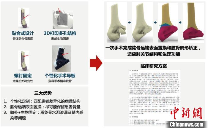 中國自主研發(fā)新型表面置換假體 填補空白、造福肘關節(jié)損傷者-肽度TIMEDOO